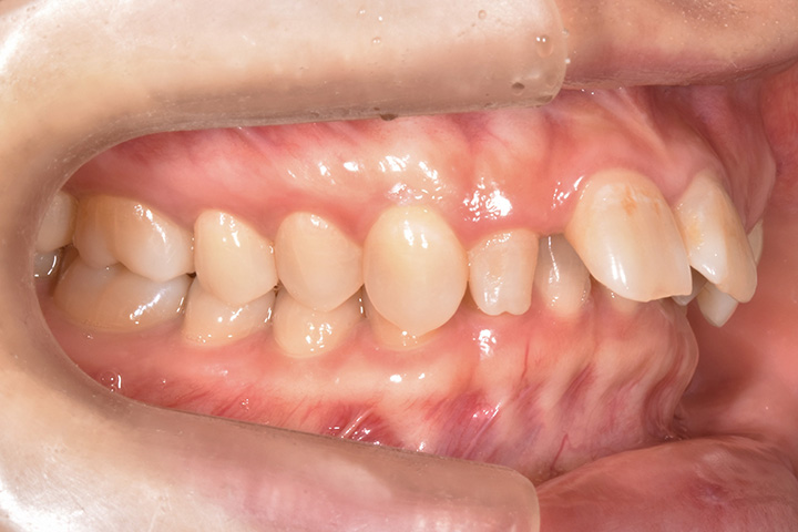 非抜歯症例-上顎前突-02