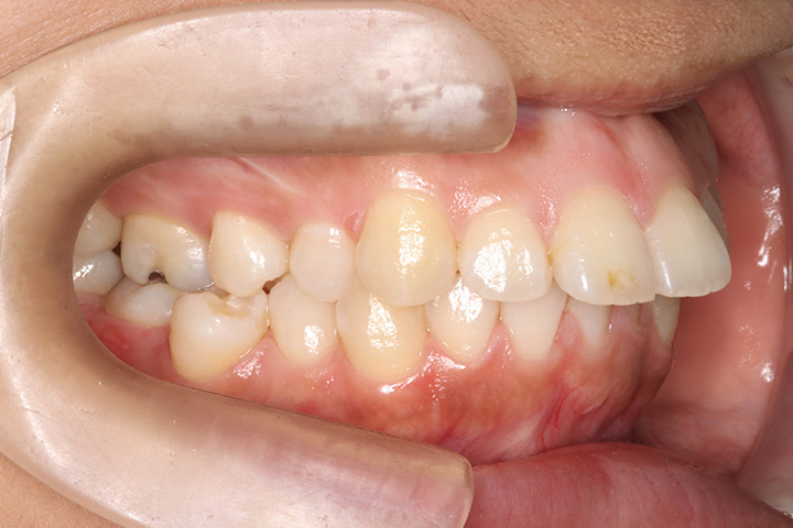 上下4本小臼歯抜歯症例-上下顎前突-03