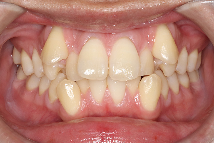 上下4本小臼歯抜歯症例-叢生-01
