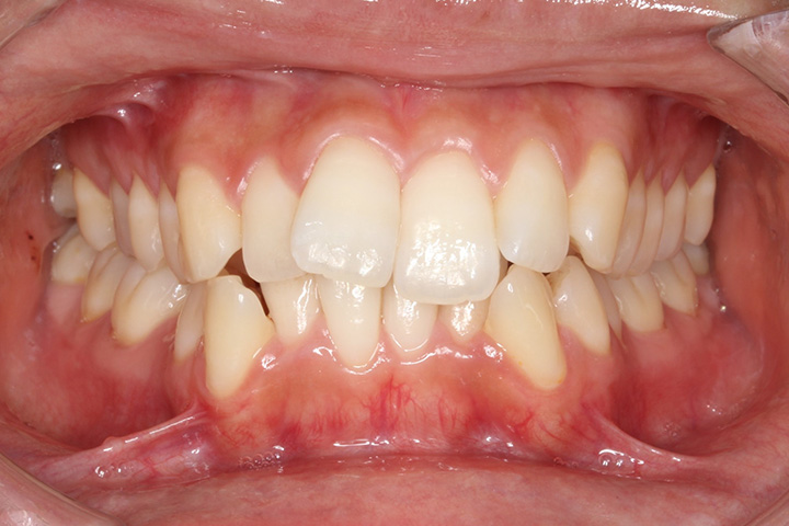 上下4本小臼歯抜歯症例-叢生-02