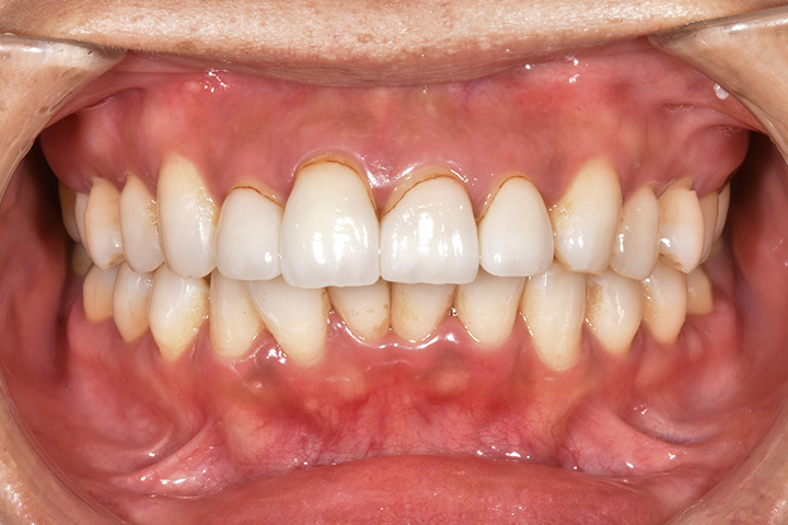 上顎2本小臼歯抜歯症例-審美補綴やインプラントを含む総合治療-01