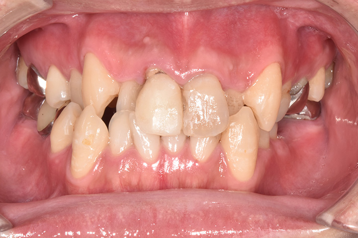 上顎前歯1本/小臼歯1本抜歯症例-審美補綴やインプラントを含む総合治療-02