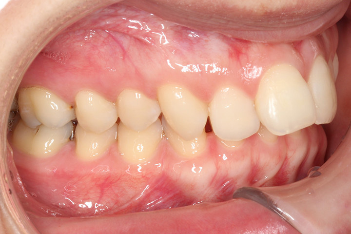 非抜歯症例-上顎前突-01