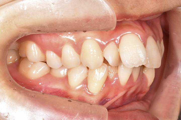 上下4本小臼歯抜歯症例-上顎前突-03