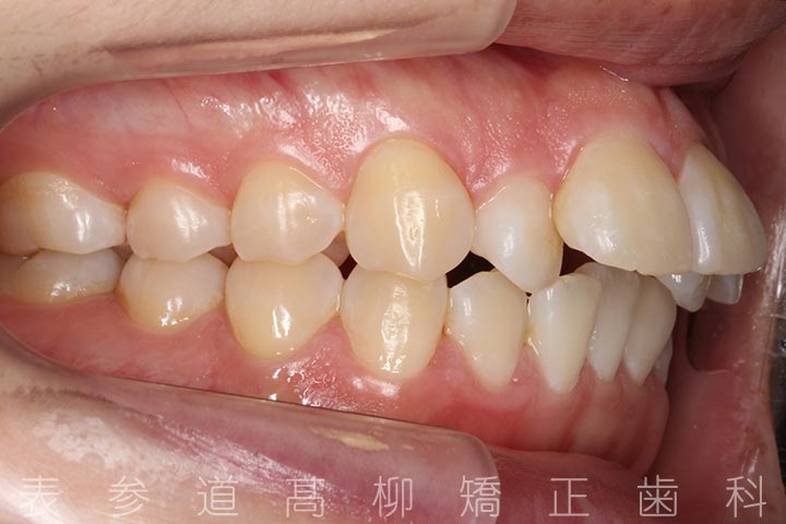 上顎2本小臼歯抜歯症例-上顎前突-04