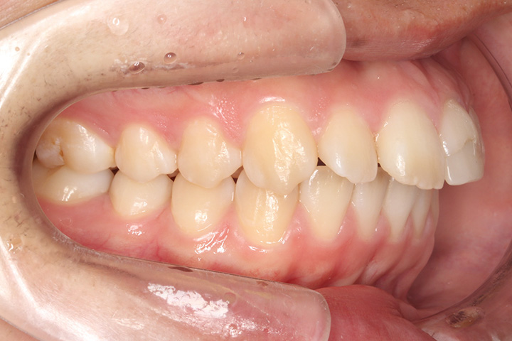 上顎2本小臼歯抜歯症例-上顎前突-05